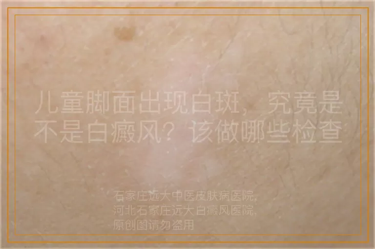 儿童脚面出现白斑，究竟是不是白癜风？该做哪些检查来明确