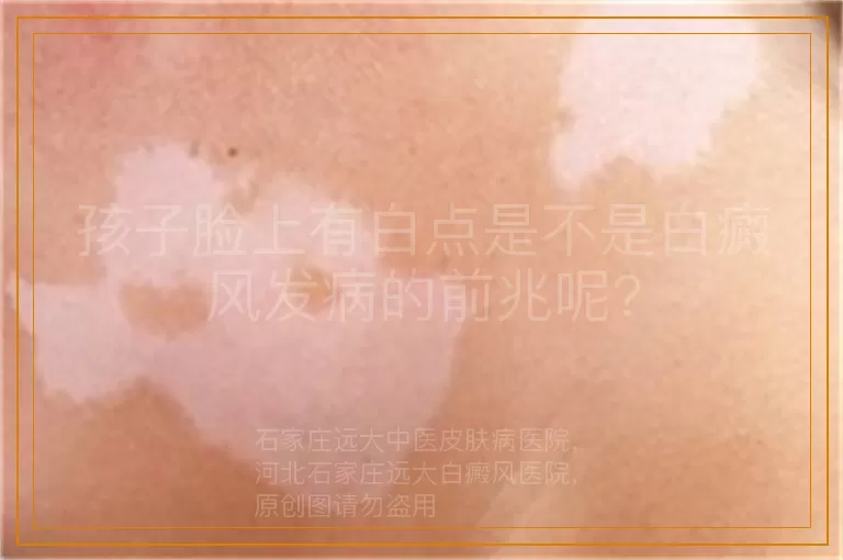 孩子脸上有白点是不是白癜风发病的前兆呢?