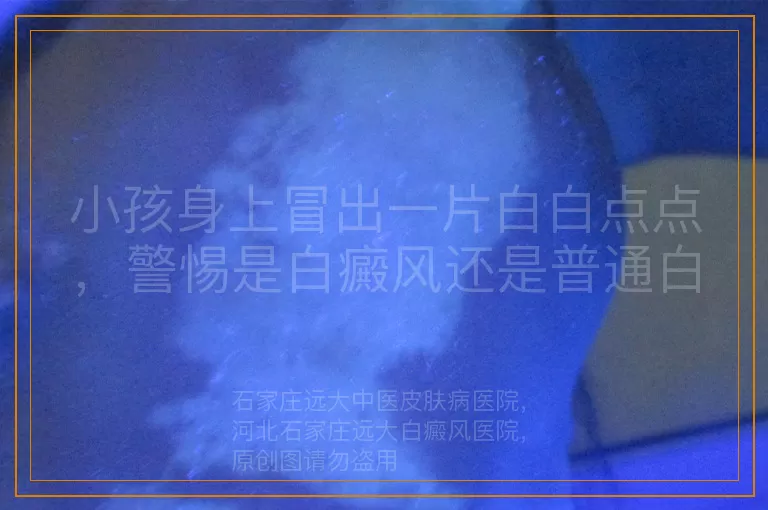 小孩身上冒出一片白白点点，警惕是白癜风还是普通白斑？