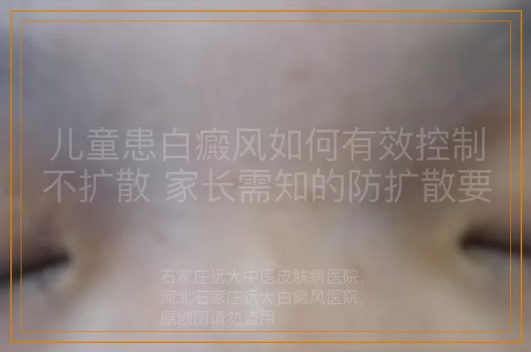 儿童患白癜风如何有效控制不扩散 家长需知的防扩散要点