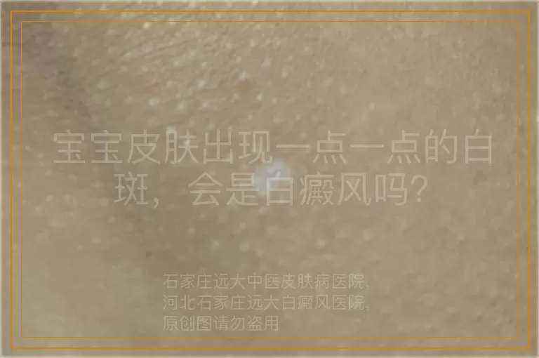 宝宝皮肤出现一点一点的白斑，会是白癜风吗？