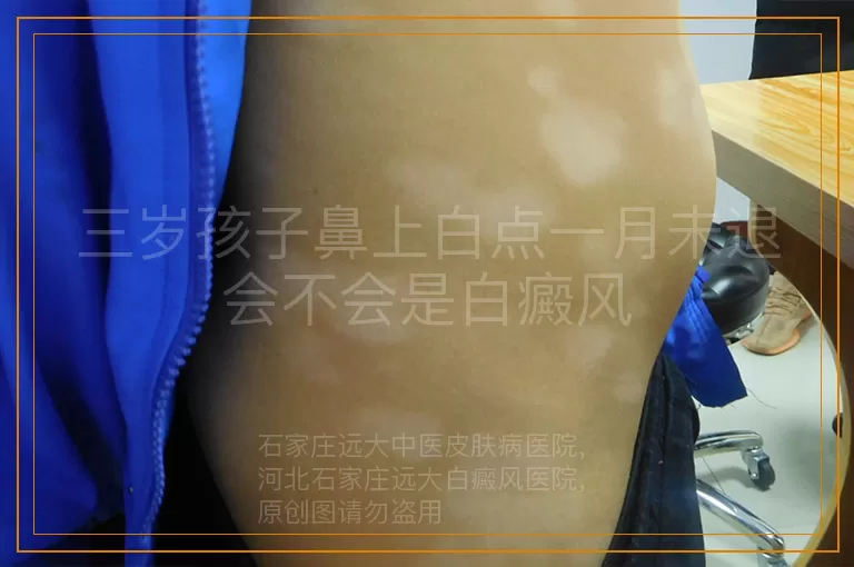 三岁孩子鼻上白点一月未退会不会是白癜风