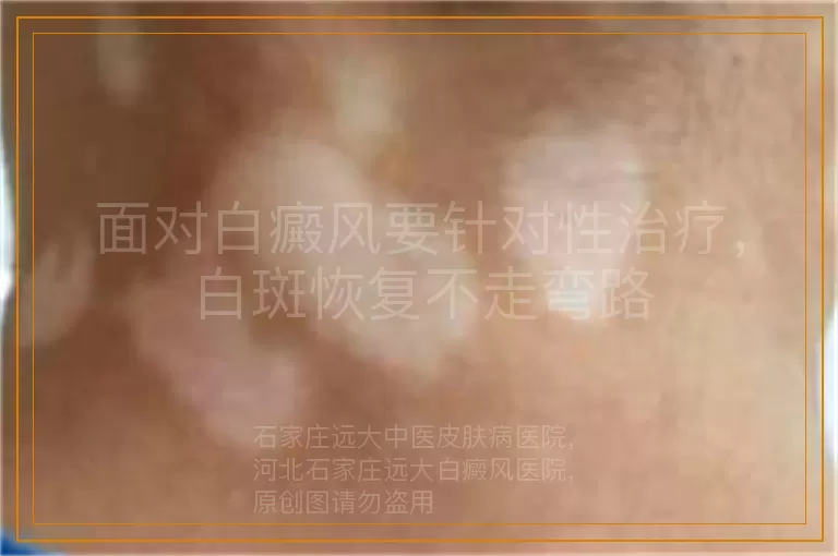 面对白癜风要针对性治疗，白斑恢复不走弯路