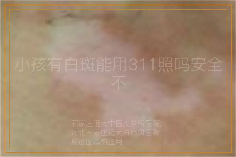 小孩有白斑能用311照吗安全不