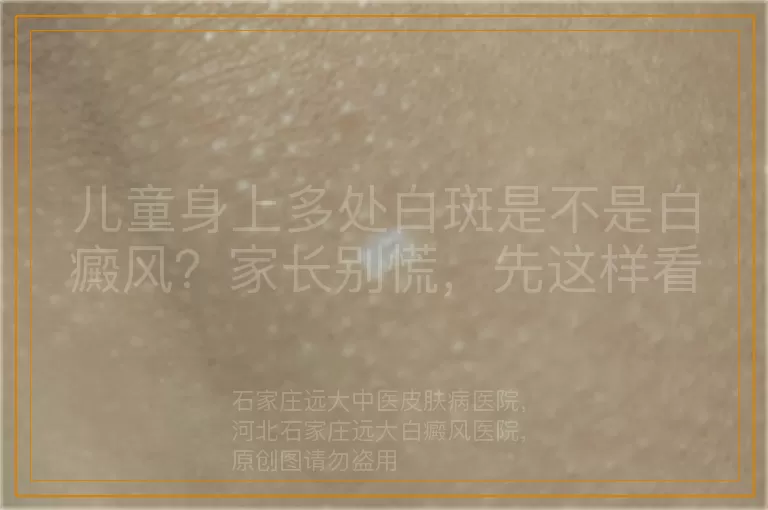 儿童身上多处白斑是不是白癜风？家长别慌，先这样看