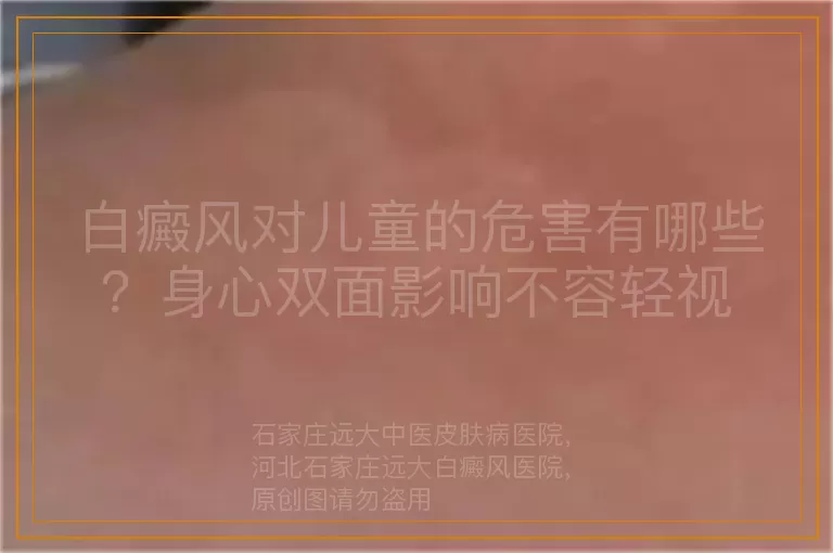 白癜风对儿童的危害有哪些？身心双面影响不容轻视