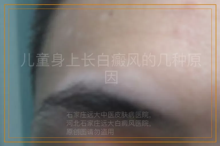 儿童身上长白癜风的几种原因