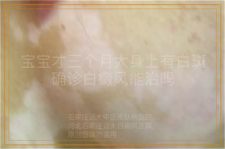 宝宝才三个月大身上有白斑确诊白癜风能治吗