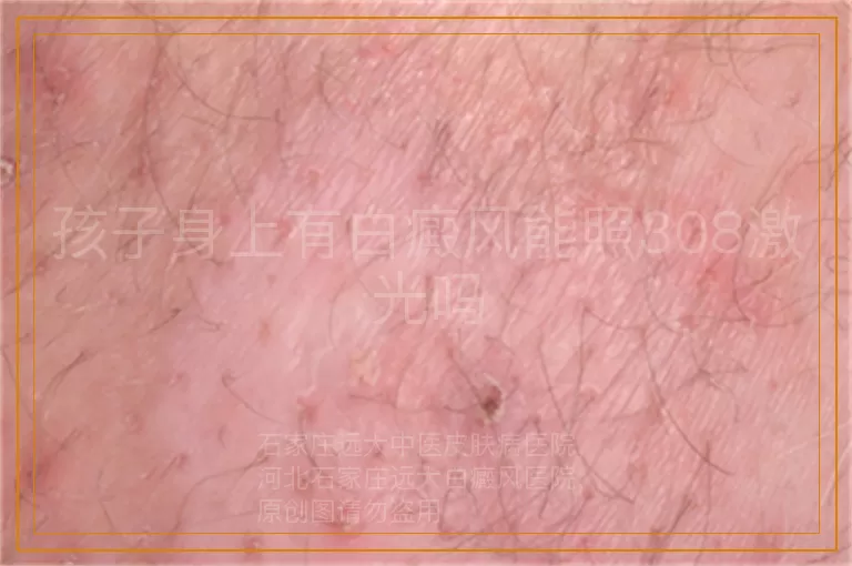 孩子身上有白癜风能照308激光吗