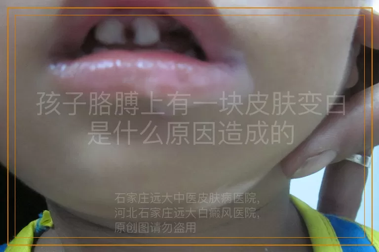 孩子胳膊上有一块皮肤变白是什么原因造成的
