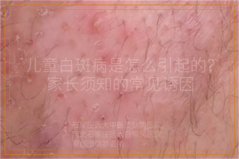 儿童白斑病是怎么引起的？家长须知的常见诱因