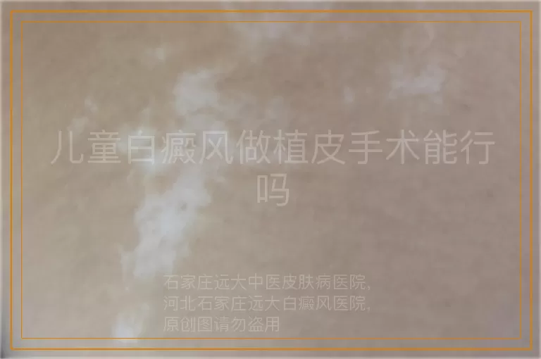 儿童白癜风做植皮手术能行吗