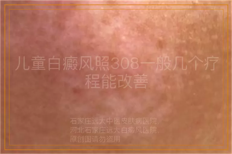 儿童白癜风照308一般几个疗程能改善