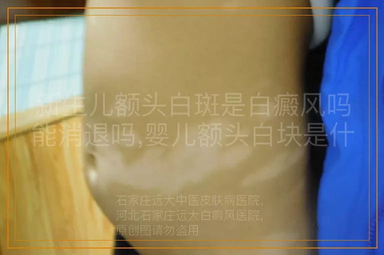 新生儿额头白斑是白癜风吗能消退吗,婴儿额头白块是什么白斑能自己消退吗,宝宝额头出现白斑会是白癜风吗会退吗
