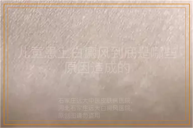 儿童患上白癜风到底是哪些原因造成的