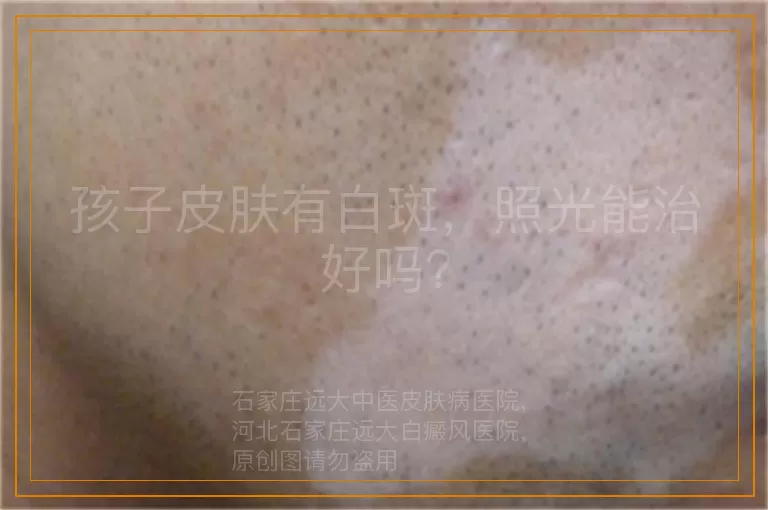 孩子皮肤有白斑，照光能治好吗？