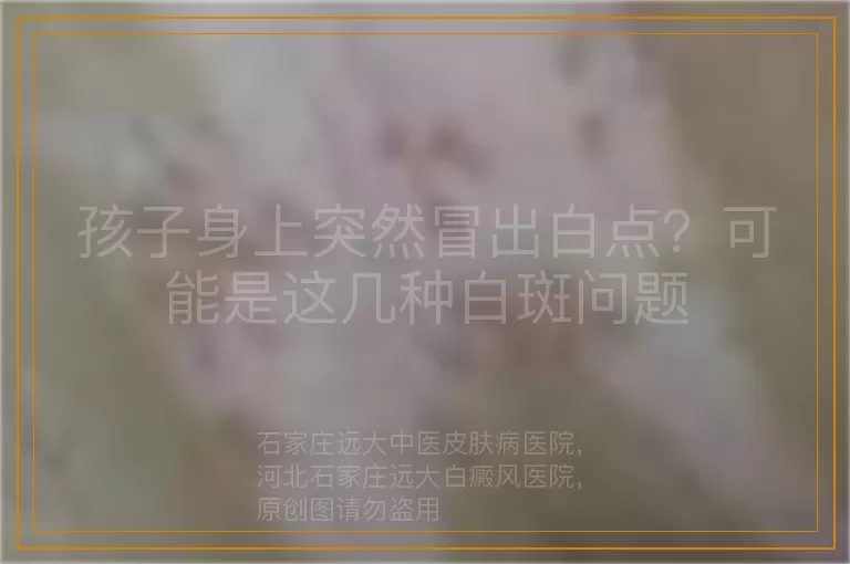 孩子身上突然冒出白点？可能是这几种白斑问题