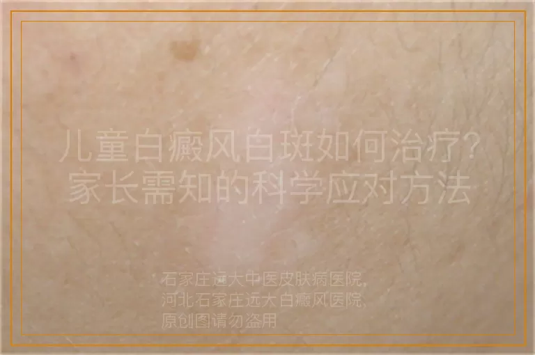 儿童白癜风白斑如何治疗？家长需知的科学应对方法