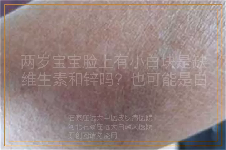 两岁宝宝脸上有小白块是缺维生素和锌吗？也可能是白癜风前兆