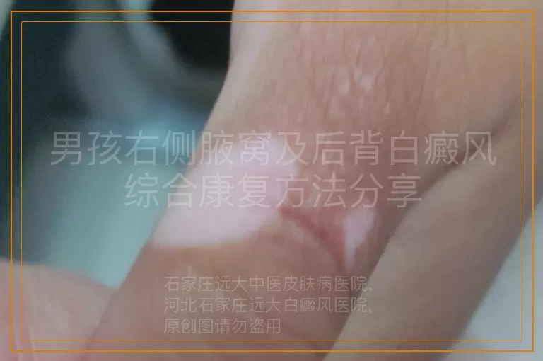 男孩右侧腋窝及后背白癜风综合康复方法分享