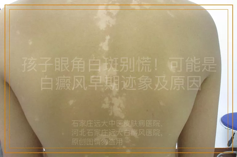 孩子眼角白斑别慌！可能是白癜风早期迹象及原因