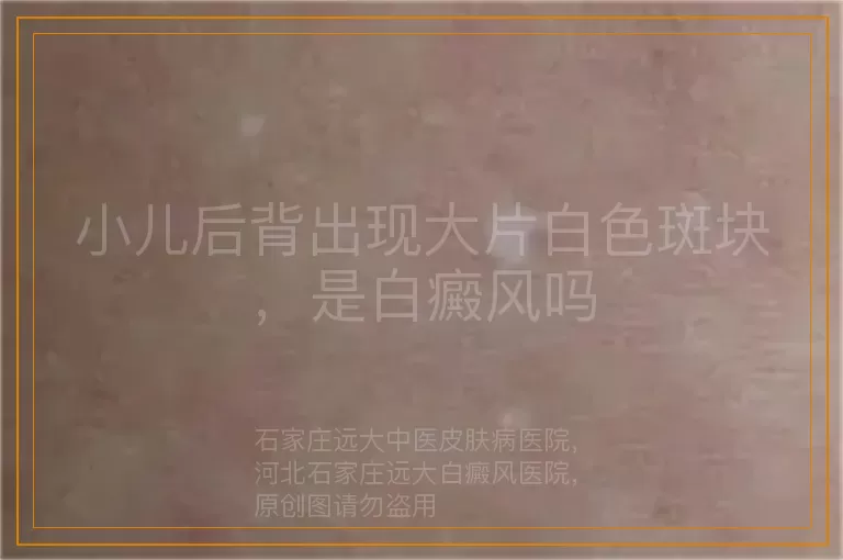 小儿后背出现大片白色斑块，是白癜风吗