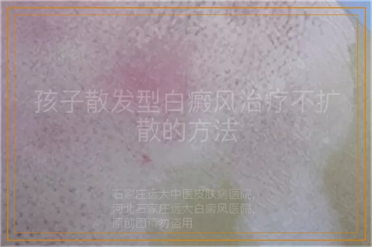 孩子散发型白癜风治疗不扩散的方法