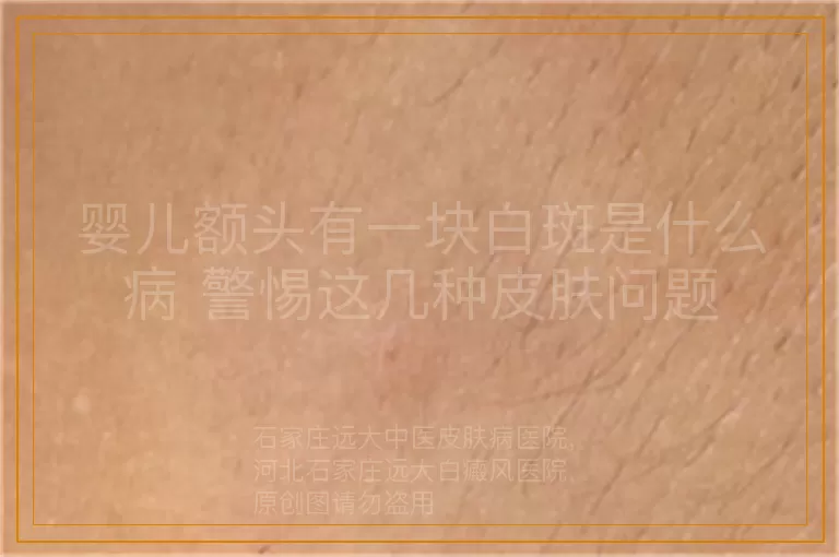 婴儿额头有一块白斑是什么病 警惕这几种皮肤问题