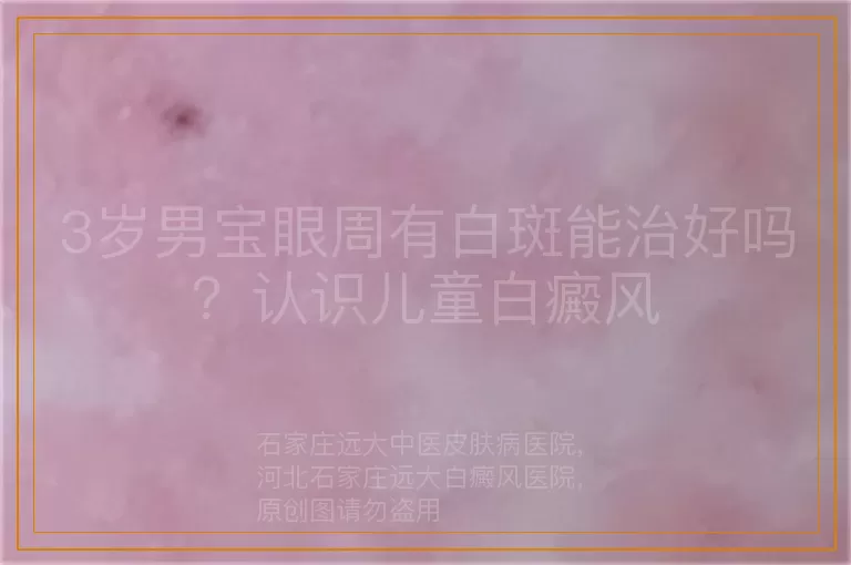 3岁男宝眼周有白斑能治好吗？认识儿童白癜风