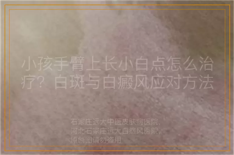 小孩手臂上长小白点怎么治疗？白斑与白癜风应对方法