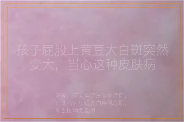 孩子屁股上黄豆大白斑突然变大，当心这种皮肤病