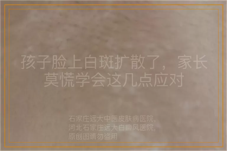 孩子脸上白斑扩散了，家长莫慌学会这几点应对