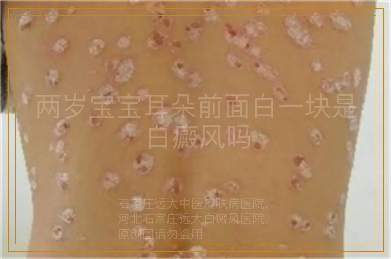 两岁宝宝耳朵前面白一块是白癜风吗