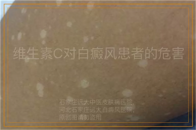 维生素C对白癜风患者的危害