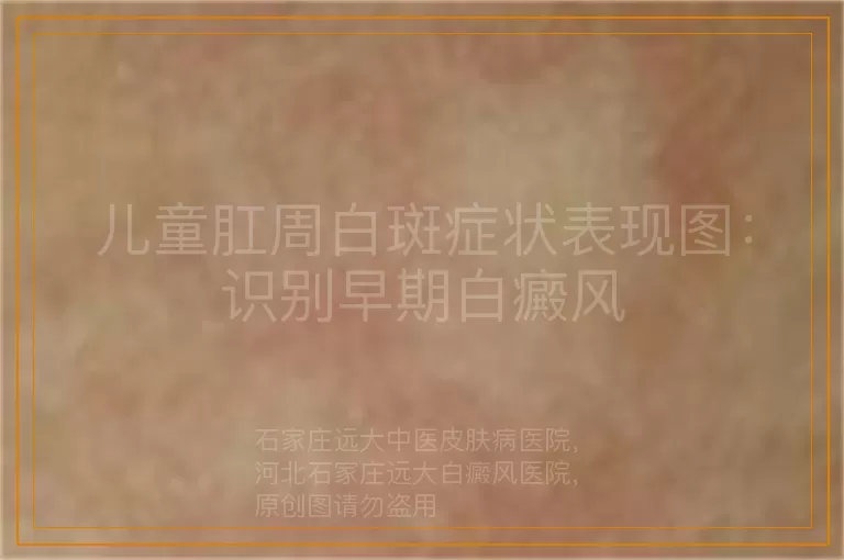 儿童肛周白斑症状表现图：识别早期白癜风