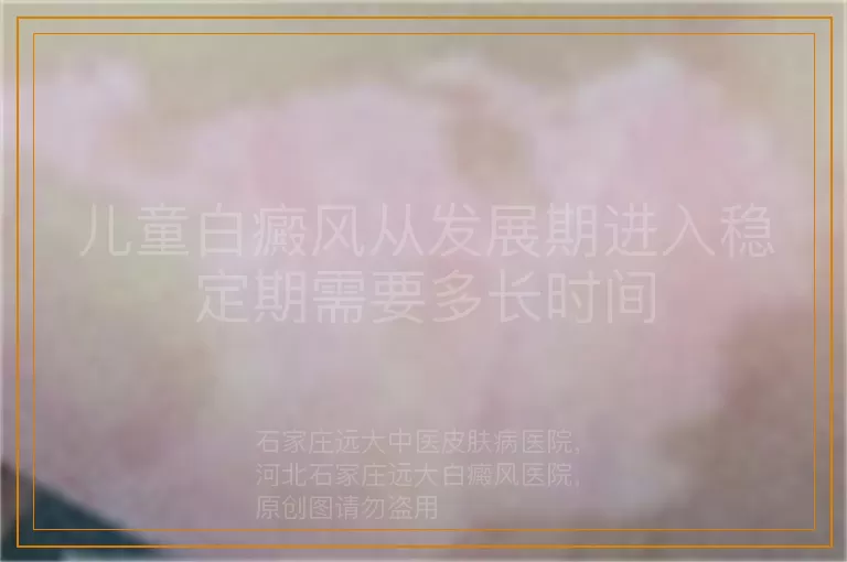 儿童白癜风从发展期进入稳定期需要多长时间