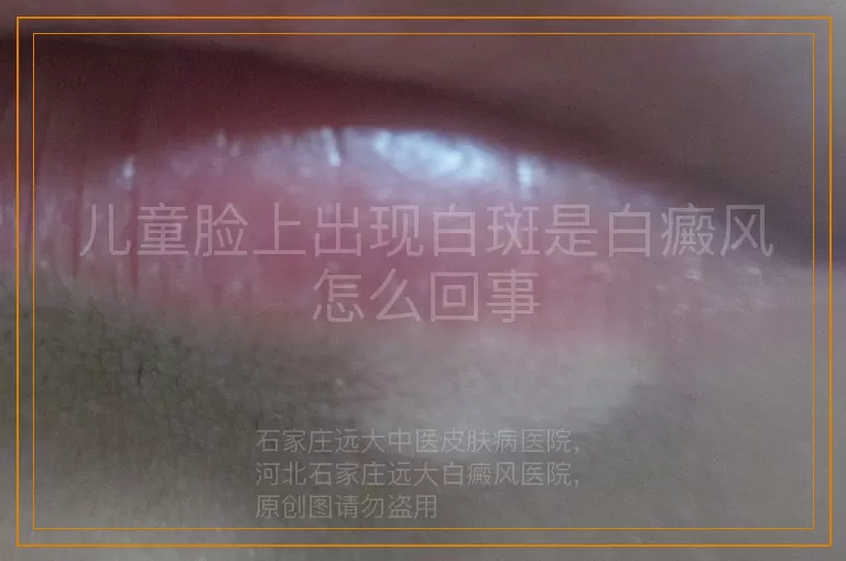 儿童脸上出现白斑是白癜风怎么回事