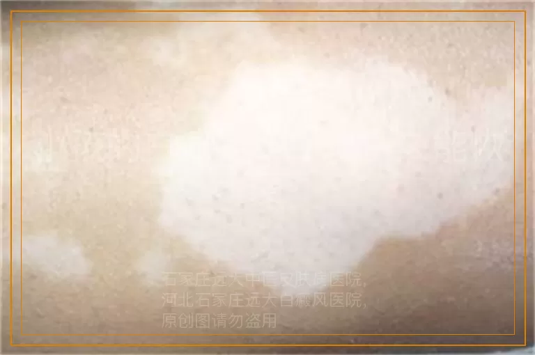 小孩的白癜风照308多久能恢复