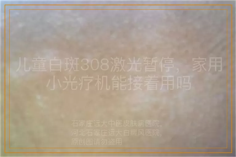 儿童白斑308激光暂停，家用小光疗机能接着用吗