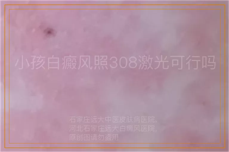 小孩白癜风照308激光可行吗