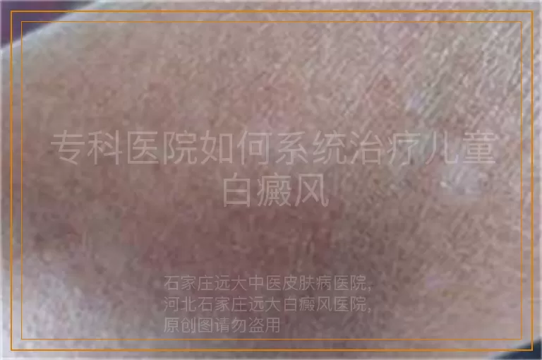 专科医院如何系统治疗儿童白癜风
