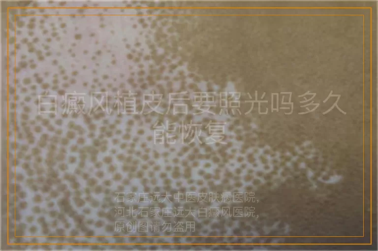白癜风植皮后要照光吗多久能恢复