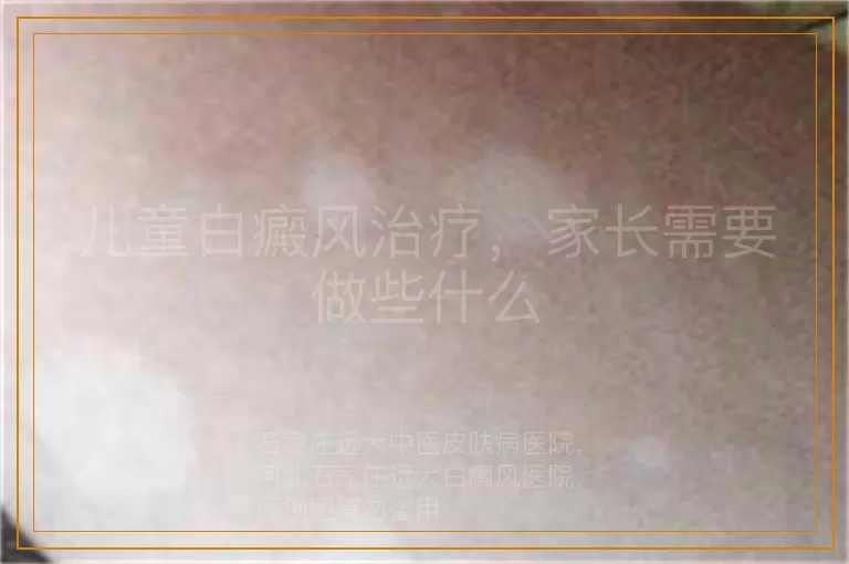 儿童白癜风治疗，家长需要做些什么