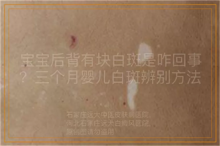 宝宝后背有块白斑是咋回事？三个月婴儿白斑辨别方法
