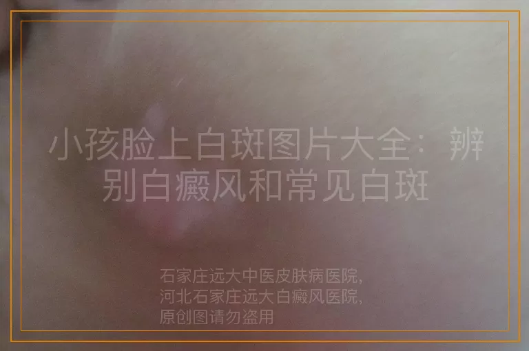 小孩脸上白斑图片大全：辨别白癜风和常见白斑