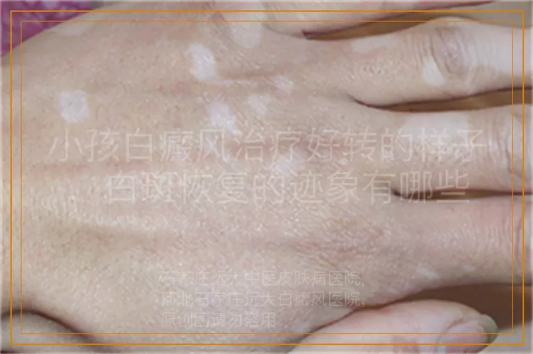 小孩白癜风治疗好转的样子，白斑恢复的迹象有哪些