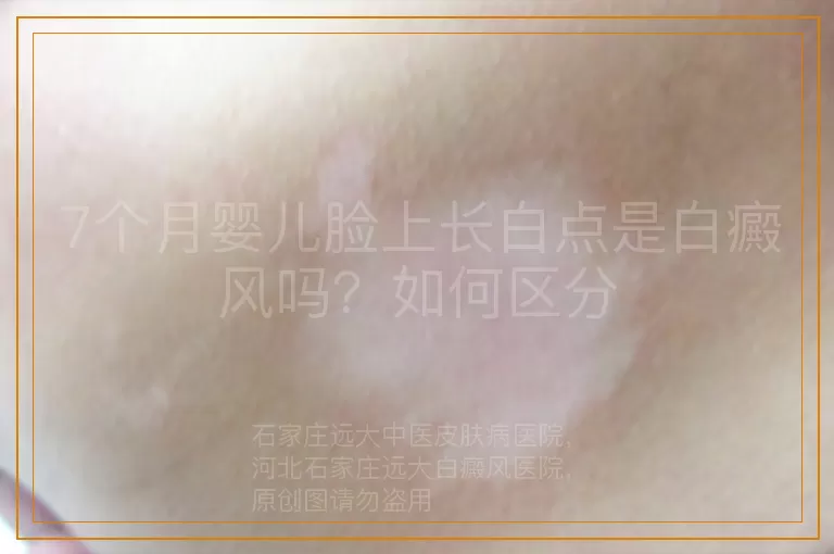 7个月婴儿脸上长白点是白癜风吗？如何区分
