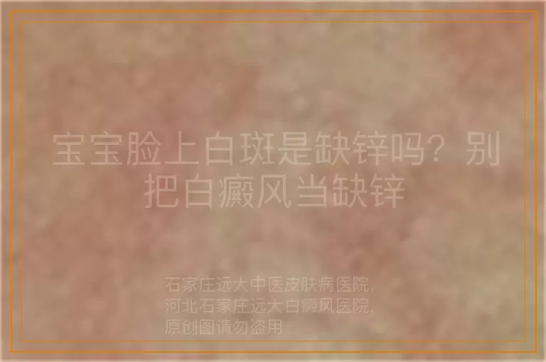 宝宝脸上白斑是缺锌吗？别把白癜风当缺锌