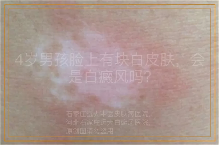 4岁男孩脸上有块白皮肤，会是白癜风吗？