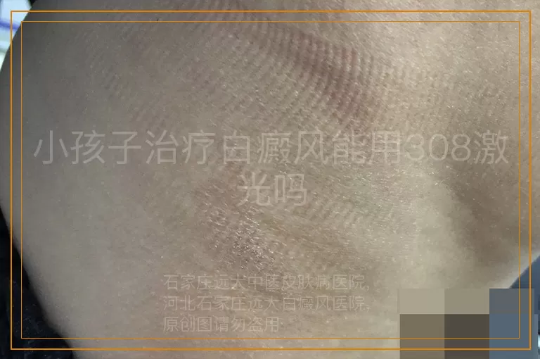 小孩子治疗白癜风能用308激光吗